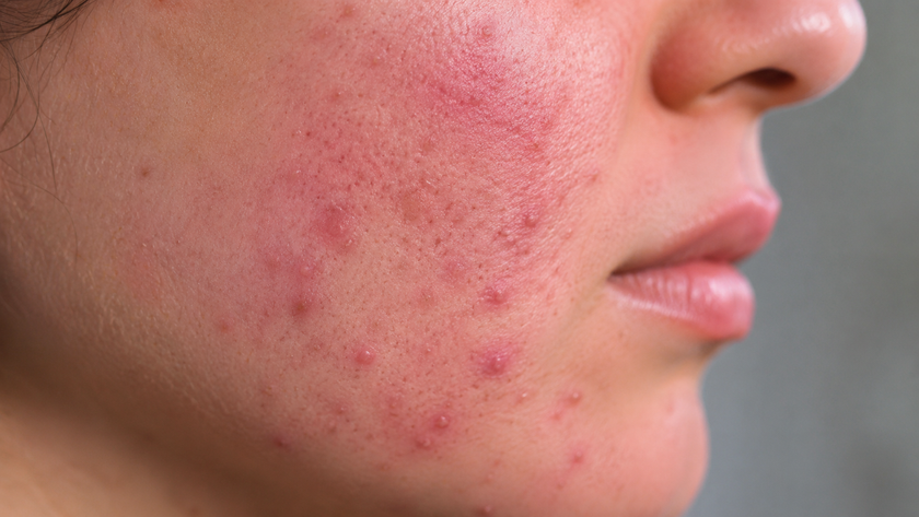 Close-up of flushed, reactive skin — redness raised across the cheek